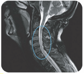 nmo-vs-ms-mri