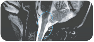 Sagittal T2-weighted area postrema MRI in an NMOSD patient