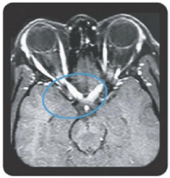 NMOSD vs MS Symptom Presentations & MRI Scans | For HCPs