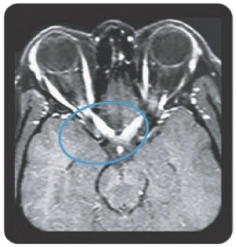 MRI scan showing an extensive Gd-enhancing lesion at the bilateral posterior part of the optic nerve/chiasm in bilateral optic neuritis, a clinical presentation observed in NMOSD vs MS