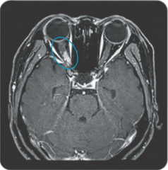 MRI scan showing a dense Gd-enhancing lesion at the posterior part of the right optic nerve in optic neuritis, a differential factor in diagnosing NMOSD vs MS