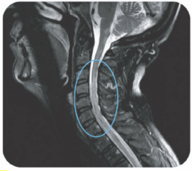 MRI scan showing longitudinally extensive transverse myelitis extending from the brain stem at the area postrema to T2, a clinical presentation observed in NMOSD vs MS